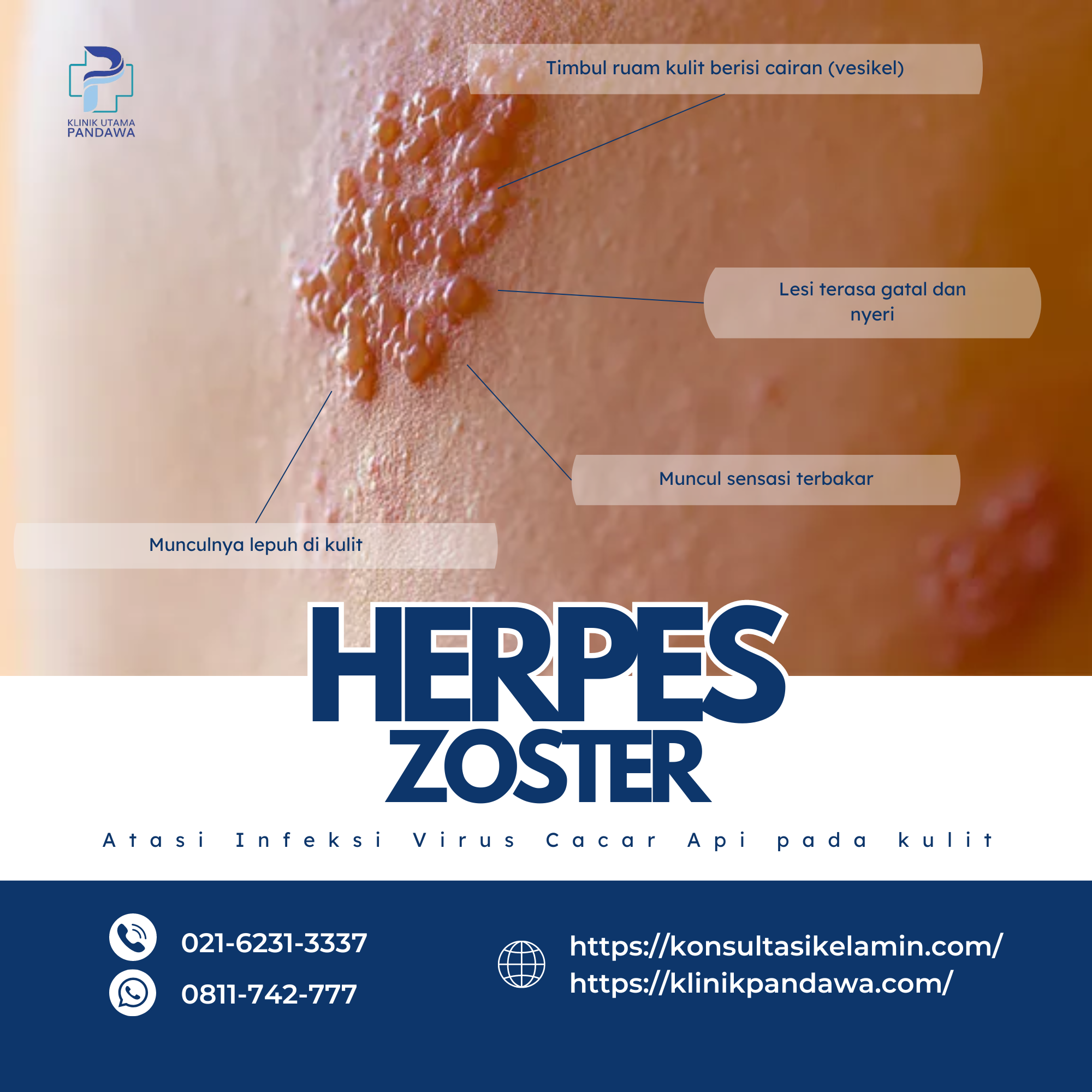 Herpes Zoster Cacar Api