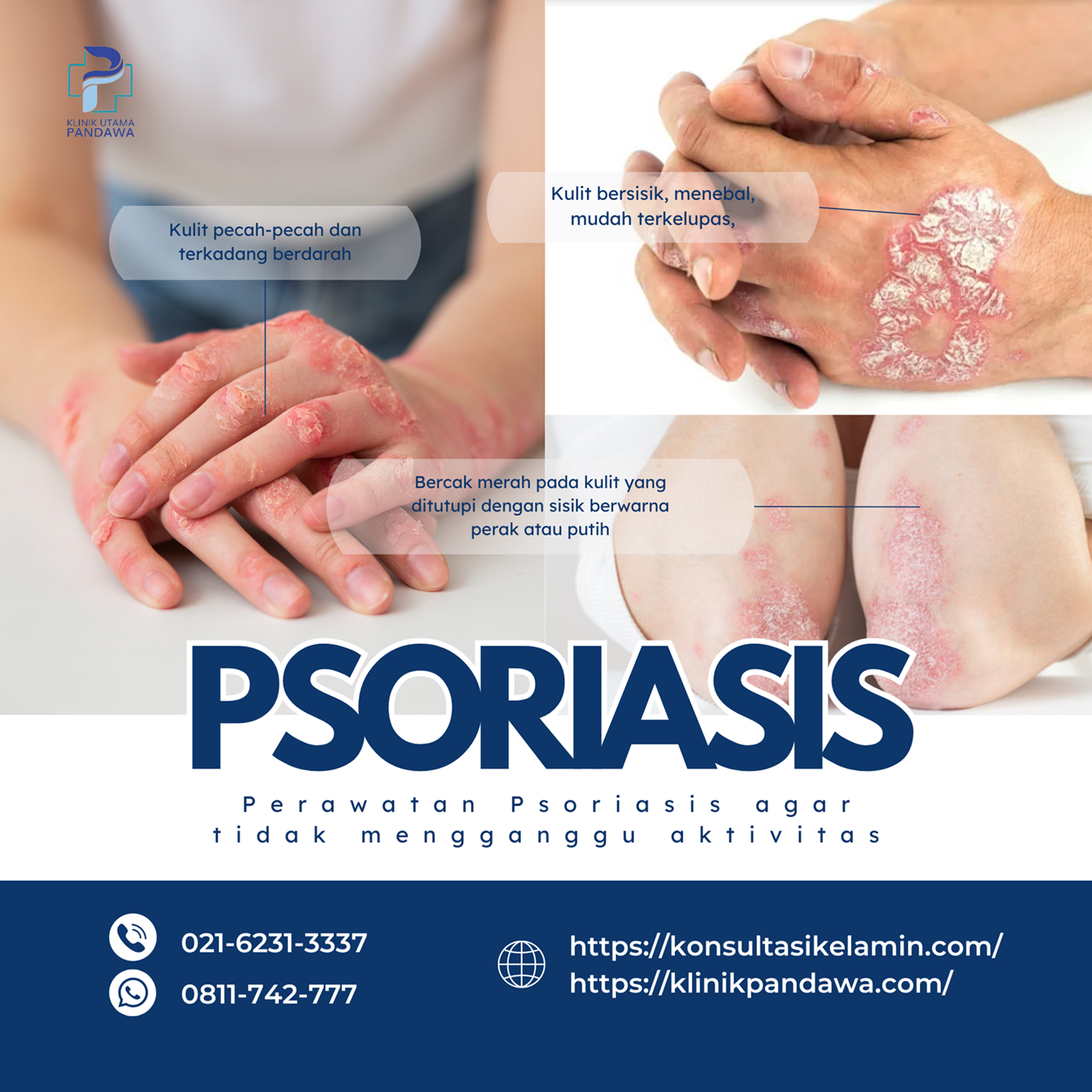 Penyakit psoriasis